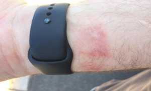 apple watch burning skin