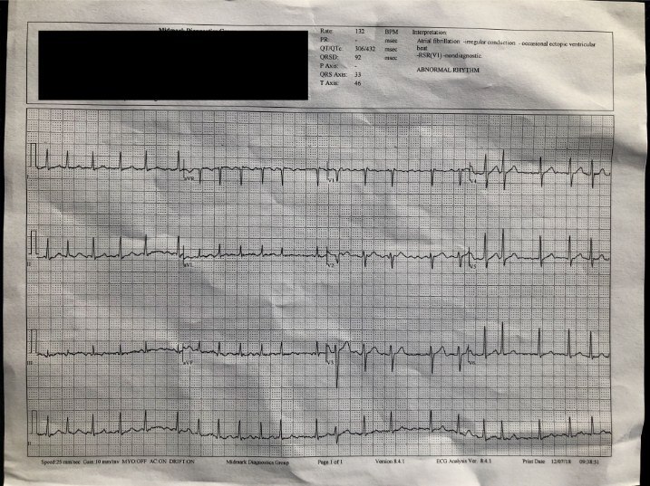 schamroth ecg pdf